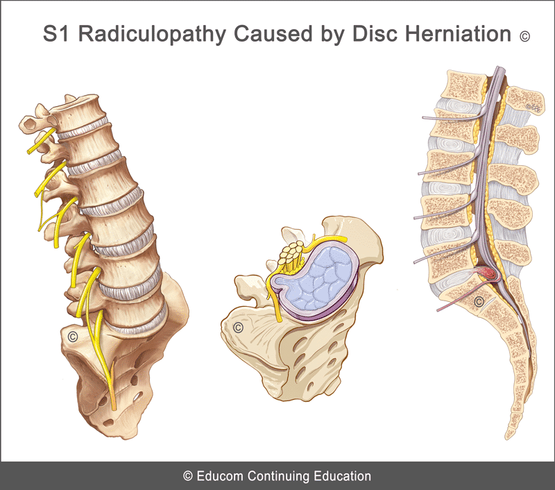 Unit 1 S1 Radiculopathy Caused by Disc HerniationLIFEWESTBU122
