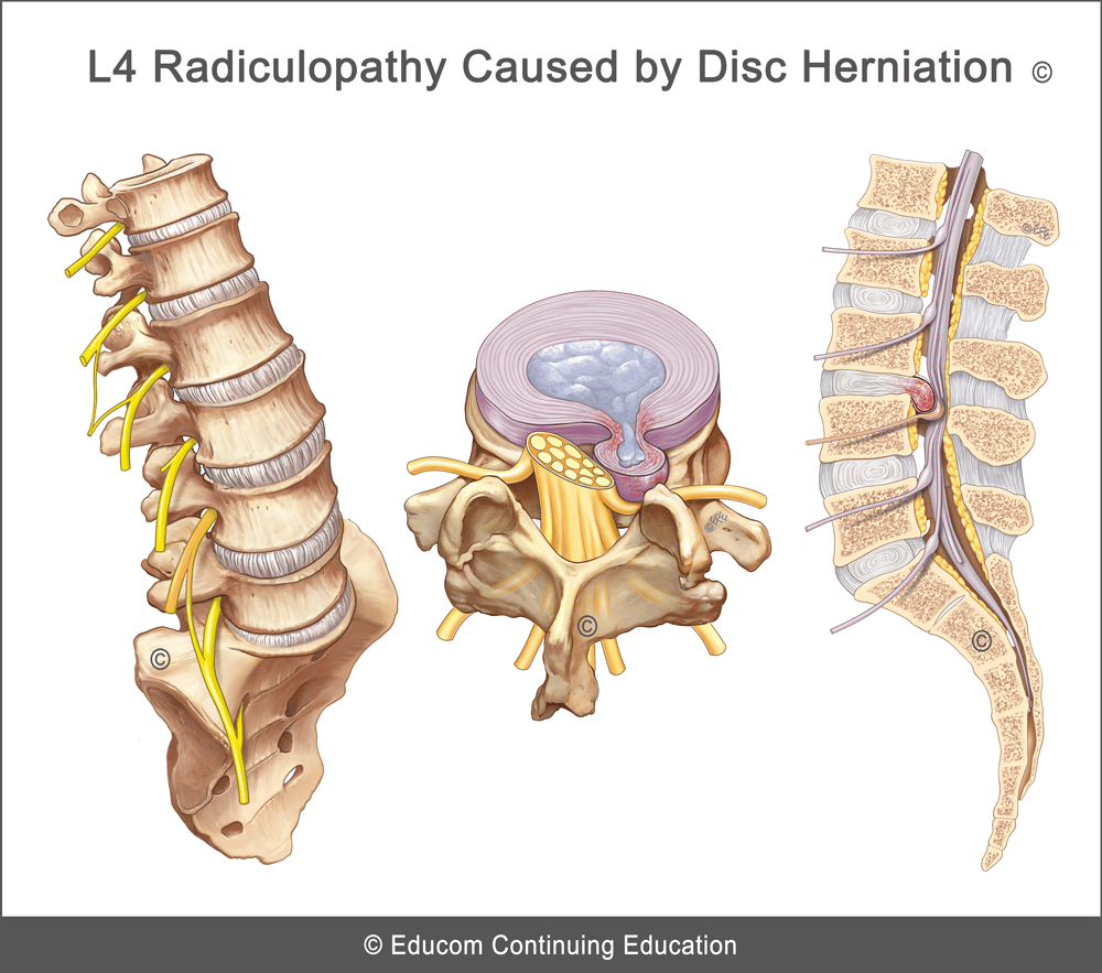 Unit 2 Disc Herniation Causing L4 Radiculopathylifewestmsdv110u2