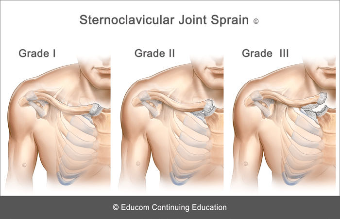 Sternoclavicular-Joint-Sprain